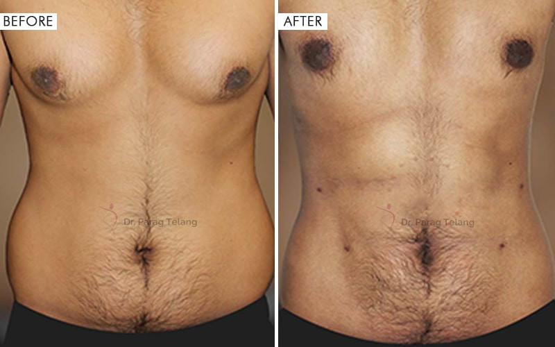 Liposuction surgery Before and After Results