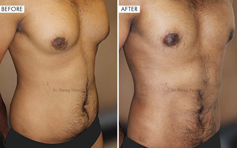 Liposuction surgery Before and After Results