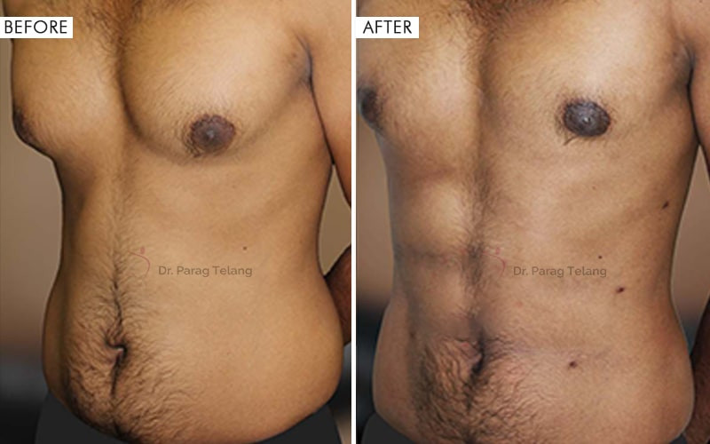 Liposuction surgery Before and After Results