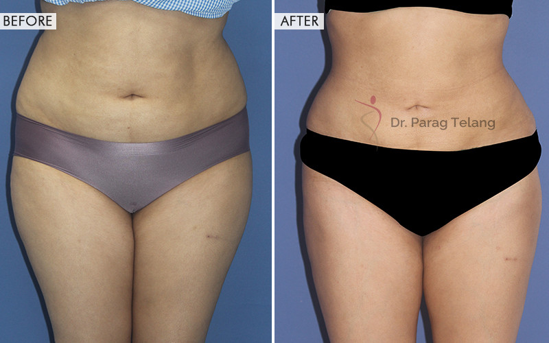 Liposuction surgery Before and After Results