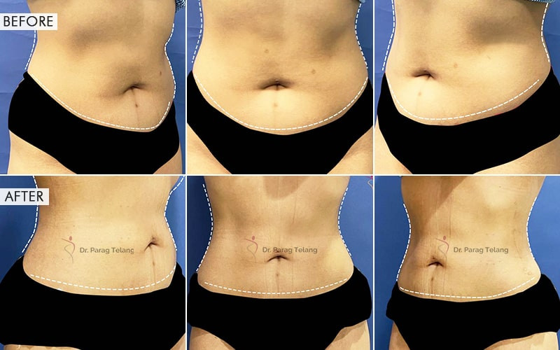 Liposuction surgery Before and After Results