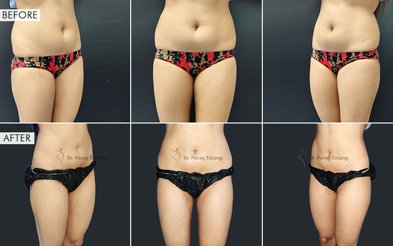 Liposuction surgery Before and After Results
