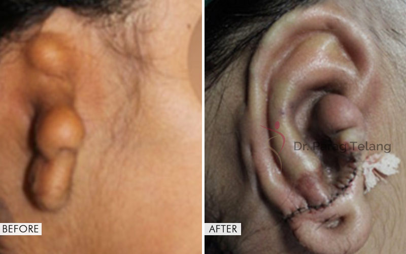 Ear Reconstruction Surgery