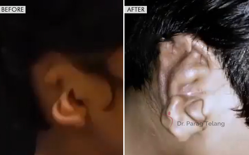 Ear Reconstruction Surgery
