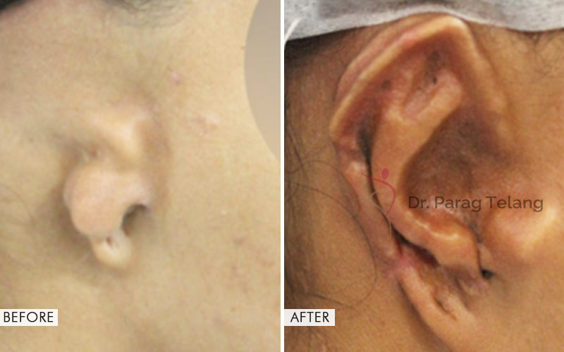 Ear Reconstruction Surgery