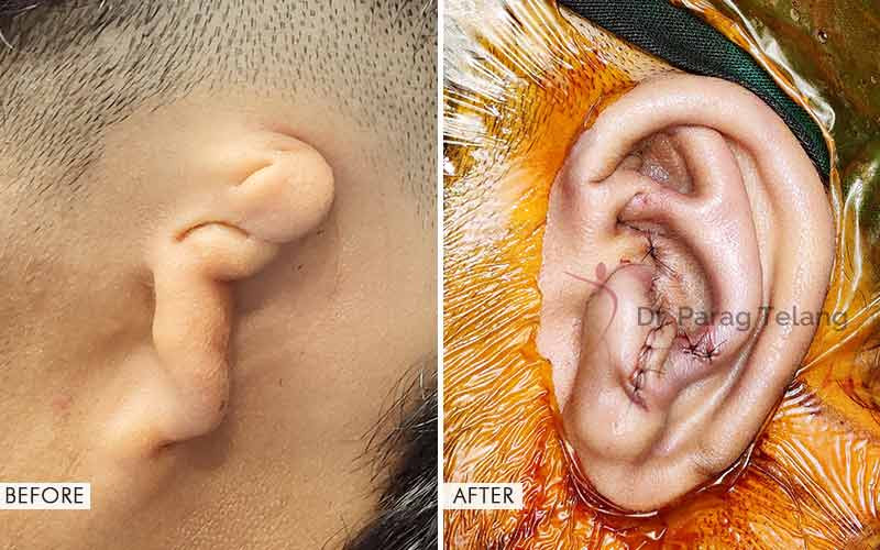 Ear Reconstruction Surgery