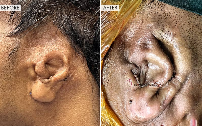 Ear Reconstruction Surgery