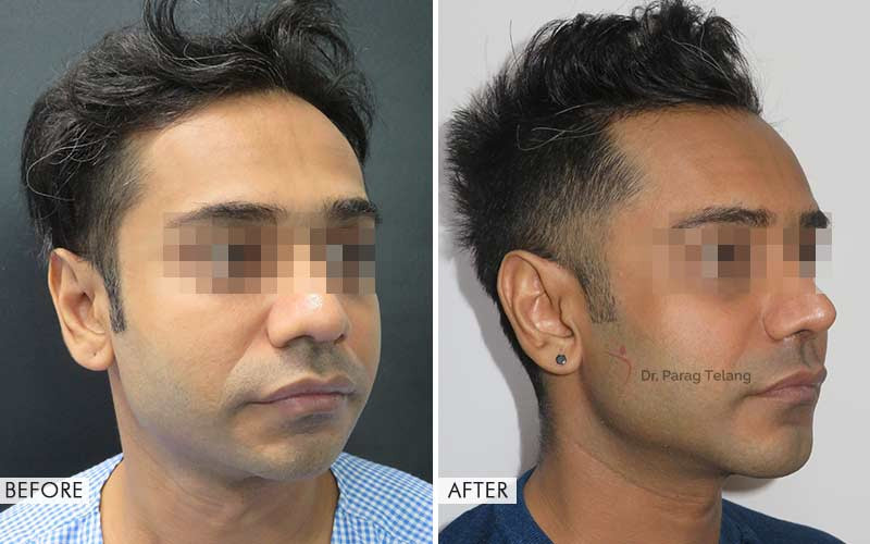 Cheek Implants