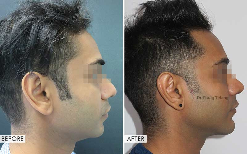 Cheek Implants