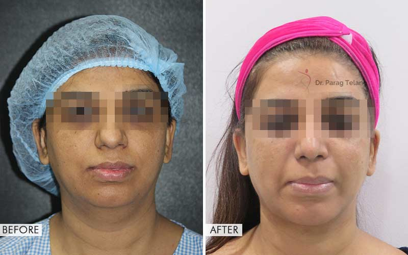 Cheek Implants
