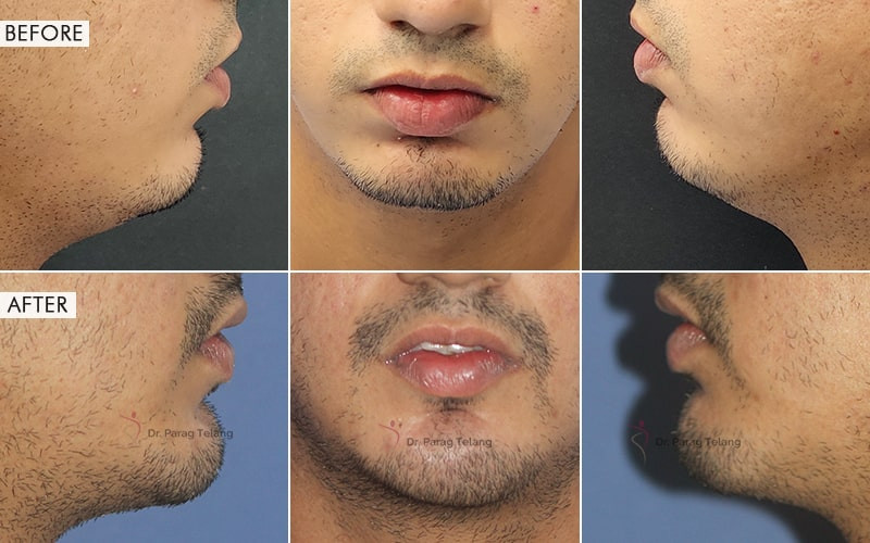 Cheek Implants