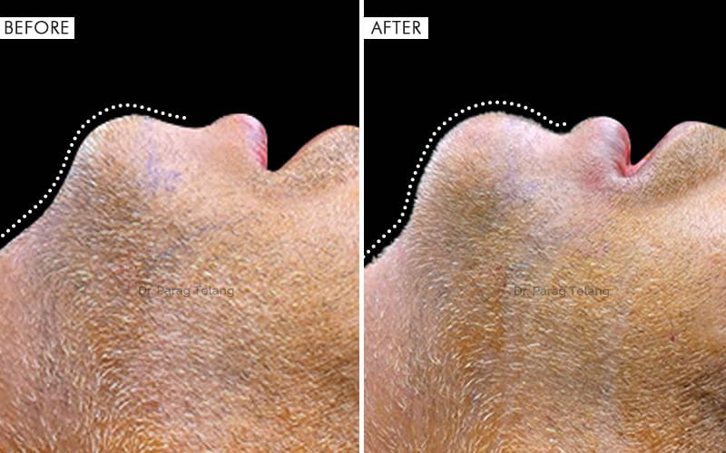 Cheek Implants