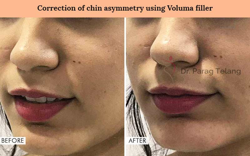 Cheek Implants