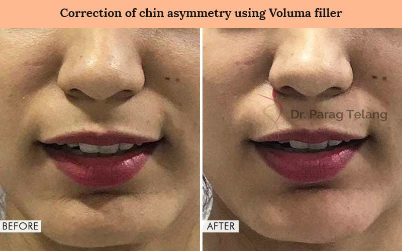 Cheek Implants