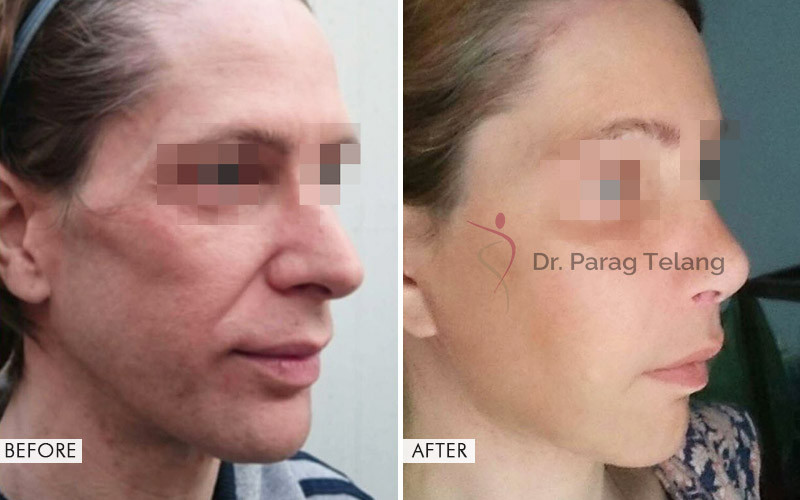 facial-feminization-surgery