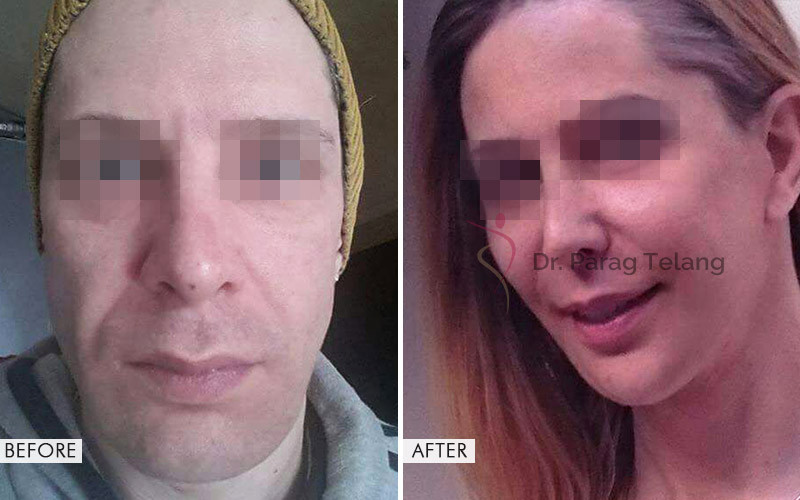 facial-feminization-surgery