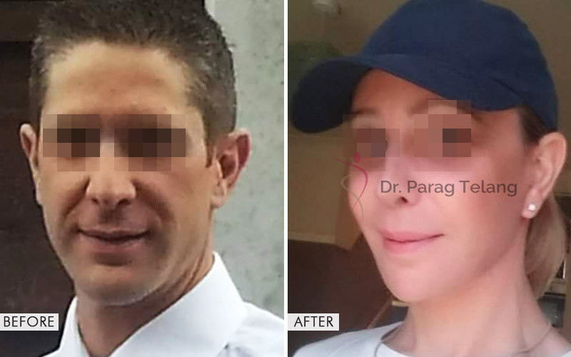 facial-feminization-surgery