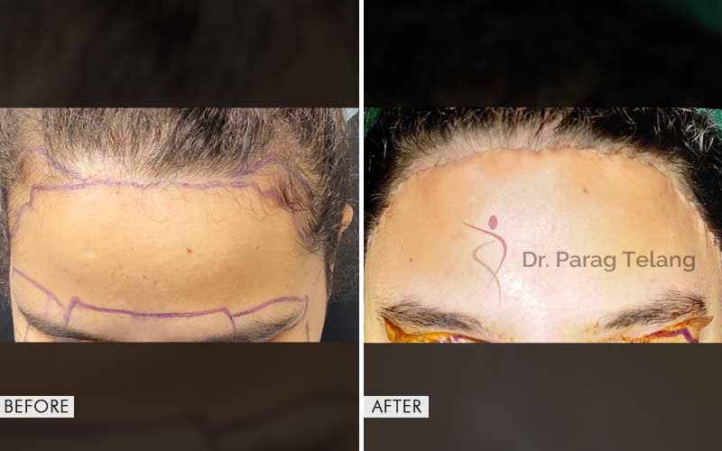 facial-feminization-surgery