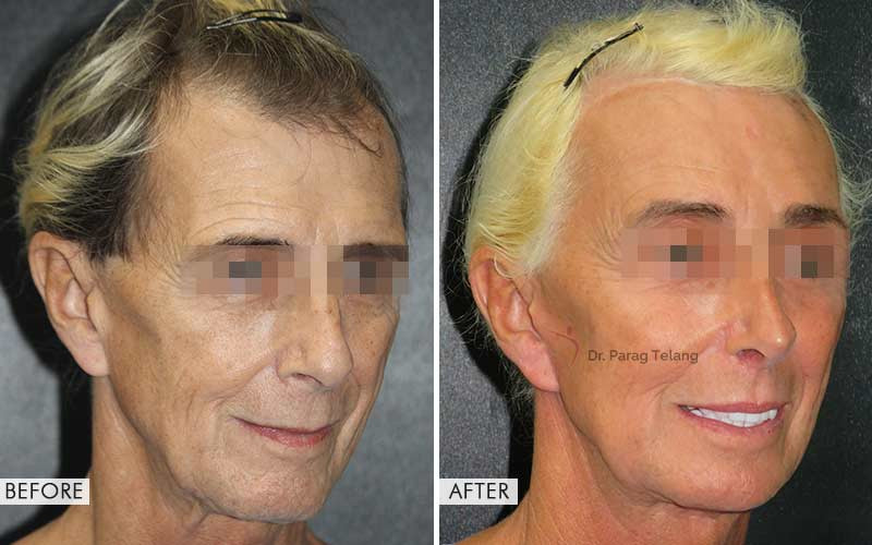 facial-feminization-surgery