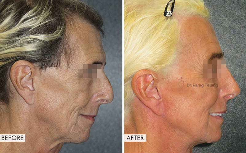 facial-feminization-surgery