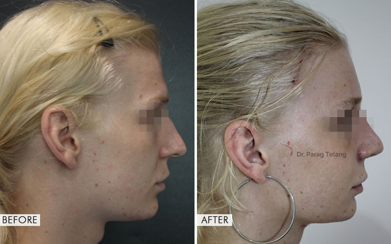 facial-feminization-surgery