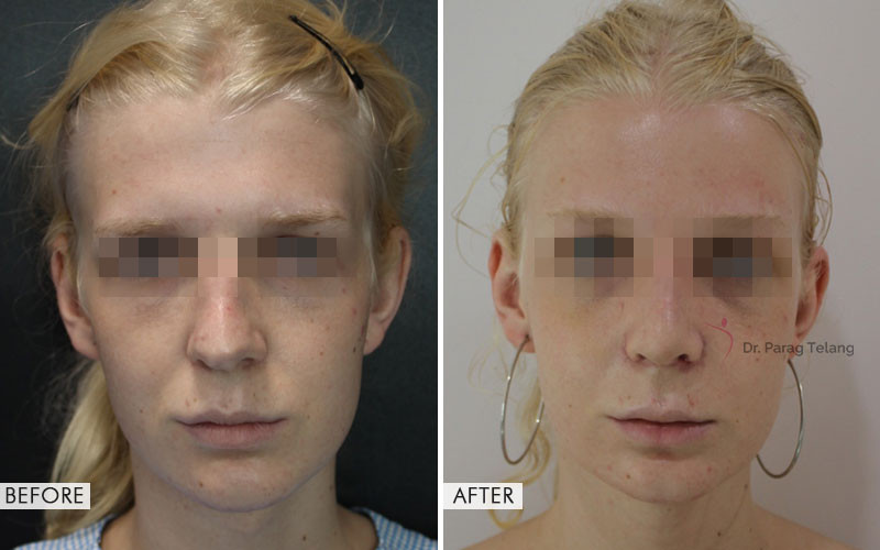 facial-feminization-surgery