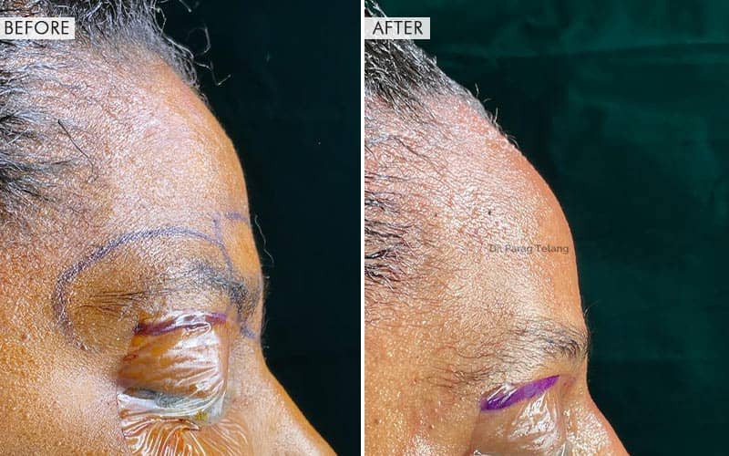 Forehead Reconstruction Type 1 & 3