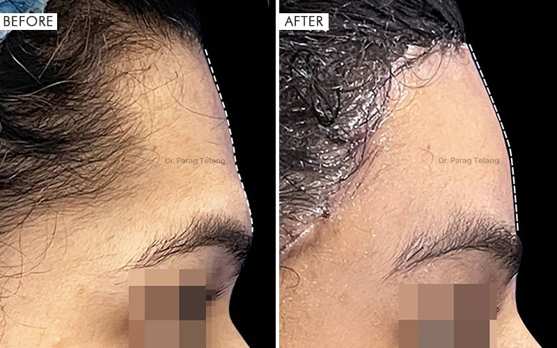 Forehead Reconstruction Type 1 & 3