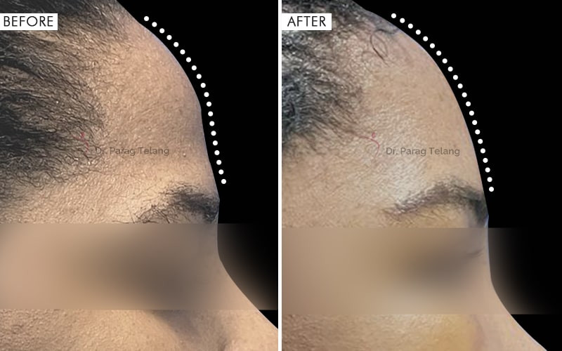 Forehead Reconstruction Type 1 & 3