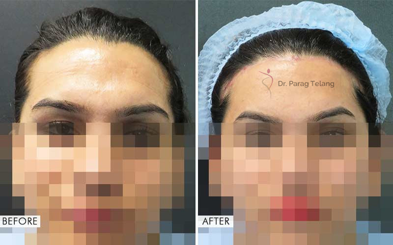 Forehead Reconstruction Type 1 & 3