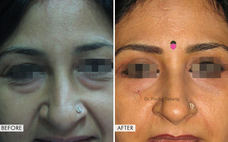 Blepharoplasty surgery Before and After Results