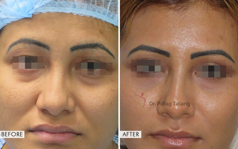 Blepharoplasty surgery Before and After Results