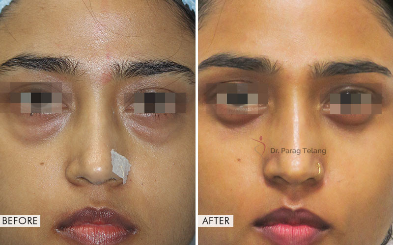 Blepharoplasty surgery Before and After Results