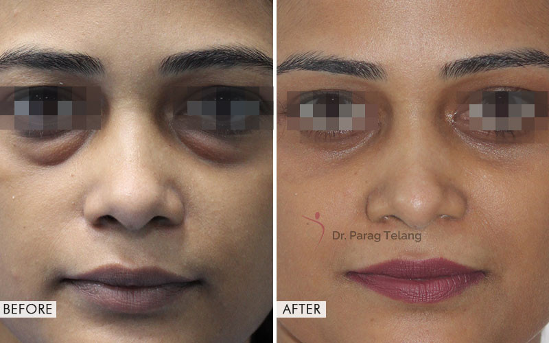 Blepharoplasty