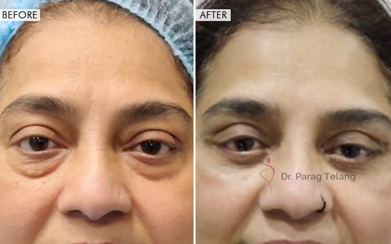Blepharoplasty