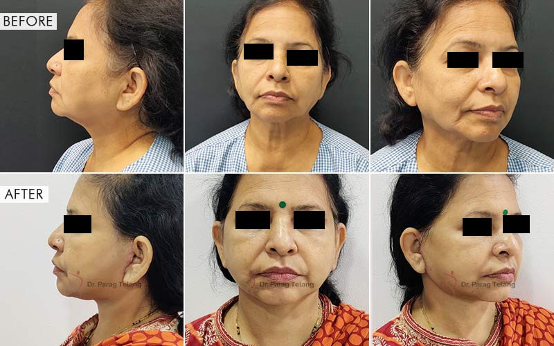 Blepharoplasty