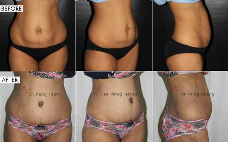 abdominoplasty surgery Before and After Results