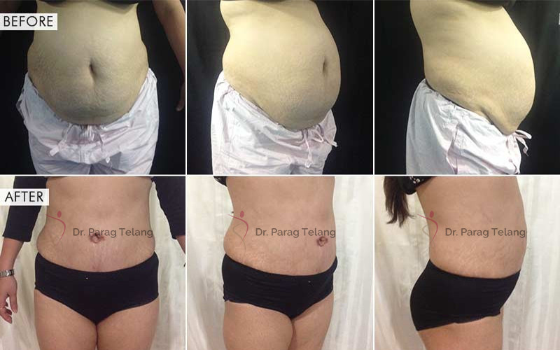 abdominoplasty surgery Before and After Results