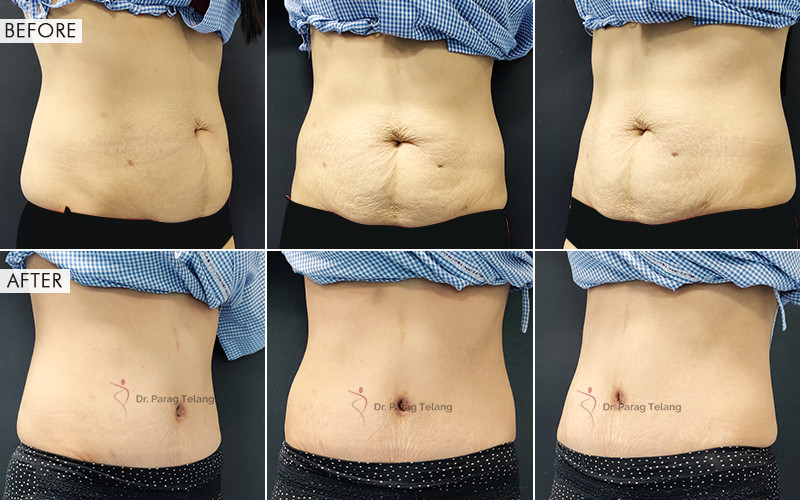 abdominoplasty surgery Before and After Results