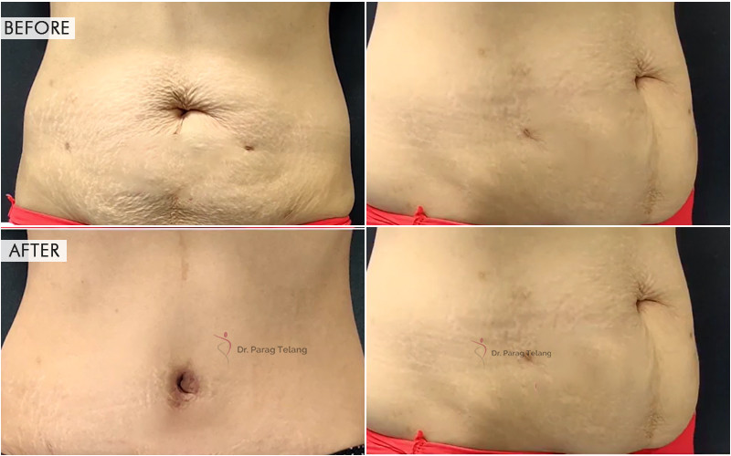 abdominoplasty