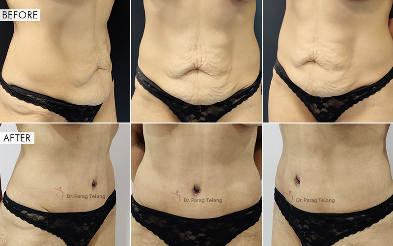 abdominoplasty