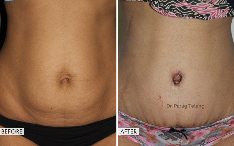 abdominoplasty