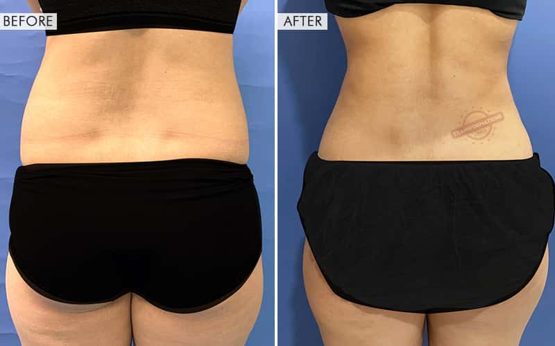 Vaser Liposuction surgery Before and After Results