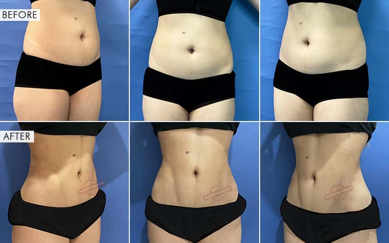 Vaser Liposuction surgery Before and After Results
