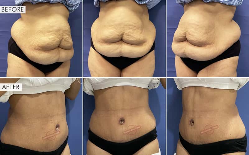 Tummy Tuck Surgery Before and After Results