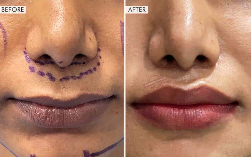 Lip Lift surgery Before and After Results