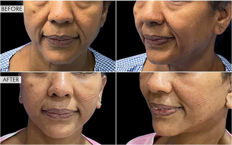 Facelift Surgery Before and After Results