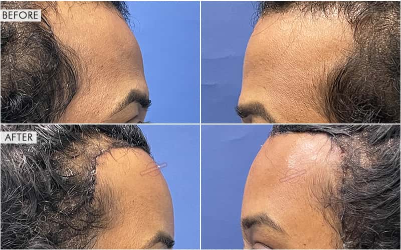 Forehead Reconstruction Type 1 & 3