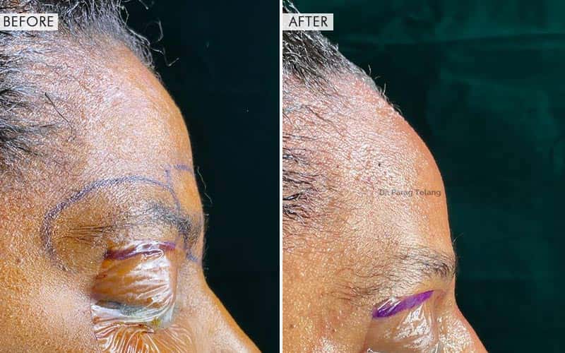 Forehead Reconstruction Type 1 & 3