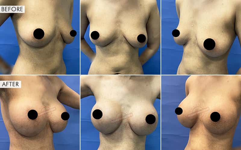 Breas-t Augmentation surgery Before and After Results